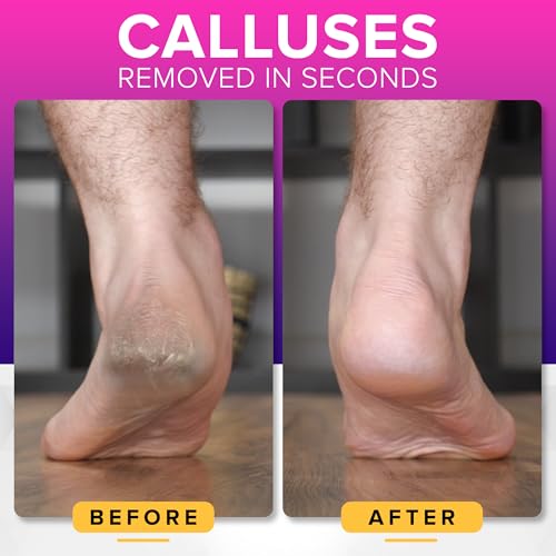RUSTPROOF Foot File Callus Remover for Feet with Catcher (XL Size) NYK1 MEGAFILE Foot Files for Hard Skin Remover for Wet & Dry Use - High-Performance Scraper with Textured Grip for Non-Slip Control